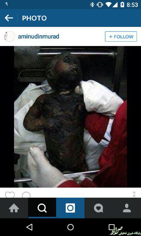 تصاویر نوزادی که صهیونیستها زنده‌زنده سوزاندند (18+)
