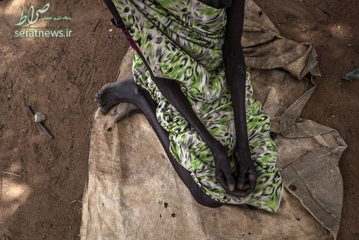 سوءتغذیه شدید یک زن در سودان