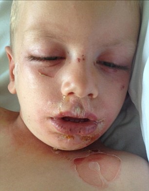 پسری با دردناک ترین بیماری پوستی +تصاویر