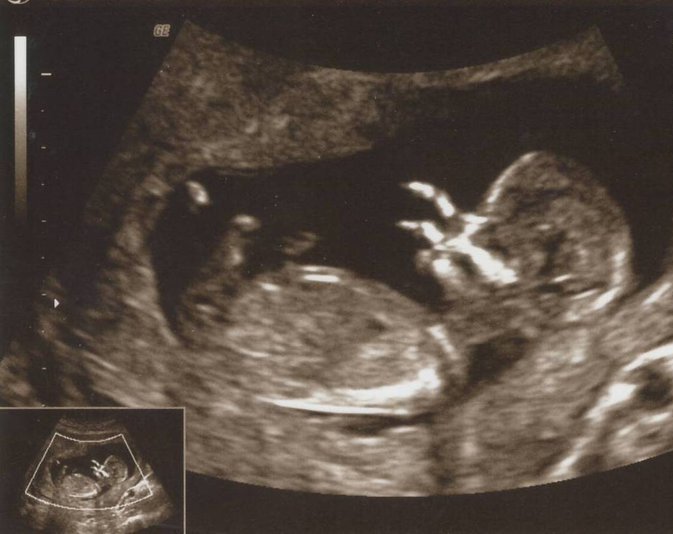 تصاویر شگفت‌انگیز از سونوگرافی جنین‌
