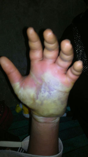 عفونت دست دانش آموز به دلیل تنبیه معلم! +تصاویر
