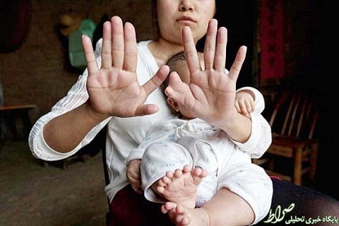 تولد پسری با 31 انگشت در دست و پا +عکس