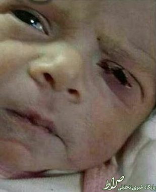 بریدگی پلک نوزاد در نطنز به تائید رسید