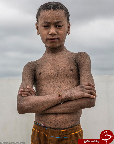 کودکانی عجیب با پوست مار +تصاویر