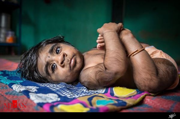 تولد پسر گرگ نما در هند+تصاویر