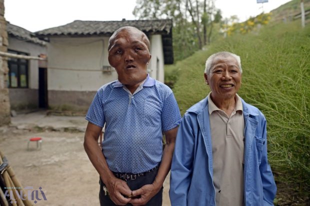 تصاویر/ بیماری عجیب و غریب مرد چینی