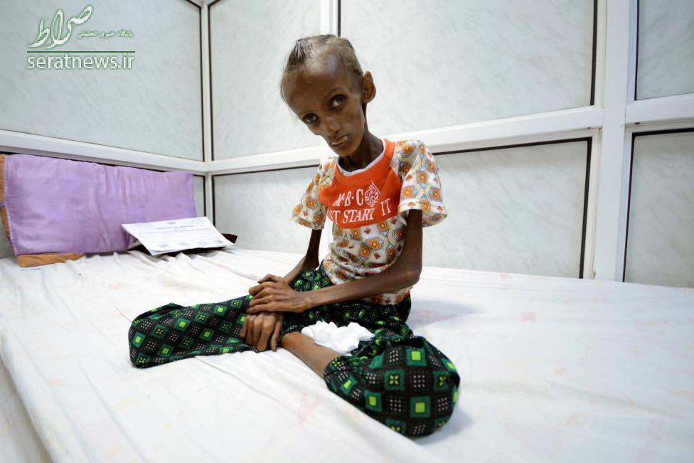 عکس/سوء تغذیه شدید دختر 18 ساله یمنی