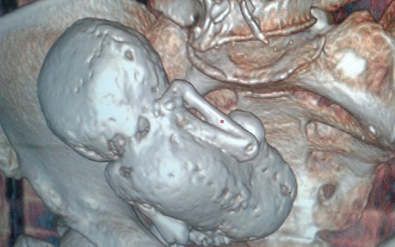 جنین سنگی 35 ساله در شکم زن الجزایری+عکس