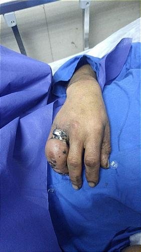 مصدومیت مردی با انگشتر تنگ +عکس