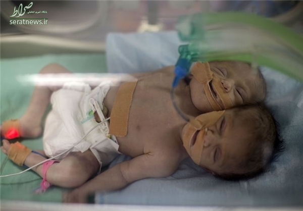 تولد نوزاد دو سر در غزه +تصاویر