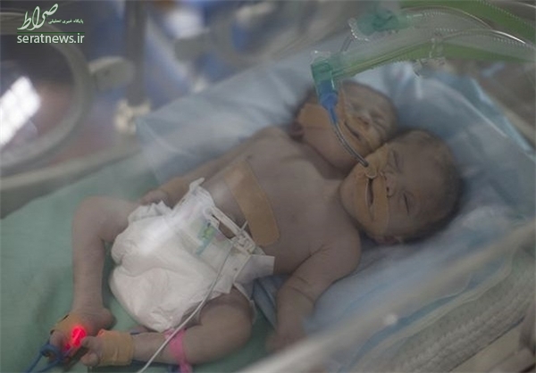 تولد نوزاد دو سر در غزه +تصاویر