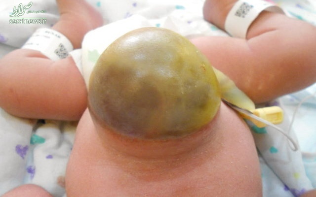 جراحی نوزادی که معده و کبد او خارج از شکمش بود +تصاویر