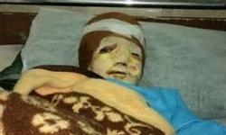آخرین وضعیت درمانی کودک سوخته شده در دیگ نذری