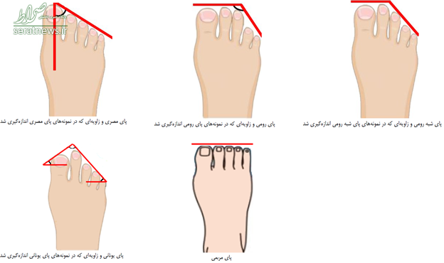 پای ایرانیان چه شکلی است؟ +عکس