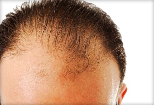 درمان انواع ریزش مو در کلینیک تخصصی پوست و مو رز