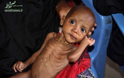 سوءتغذیه علی حسن کودک 9 ماهه اهل سومالی که به همراه مادرش در پی خشکسالی جنوب سومالی به یک اردوگاه در موگادیشو آمده است